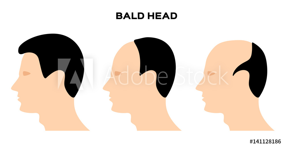 1000x518 Photo Art Print Bald Head Vector No Hair Europosters