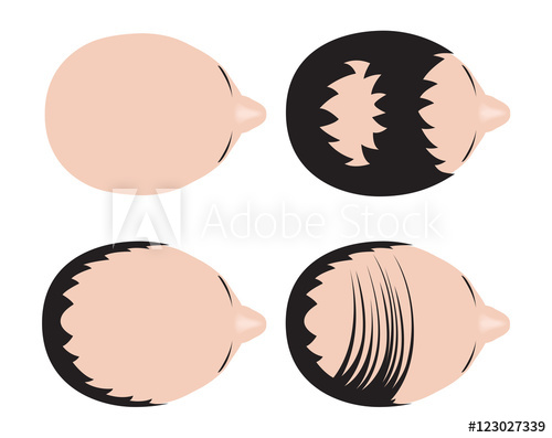 500x397 Type Of Baldness Bald Head Vector No Hair