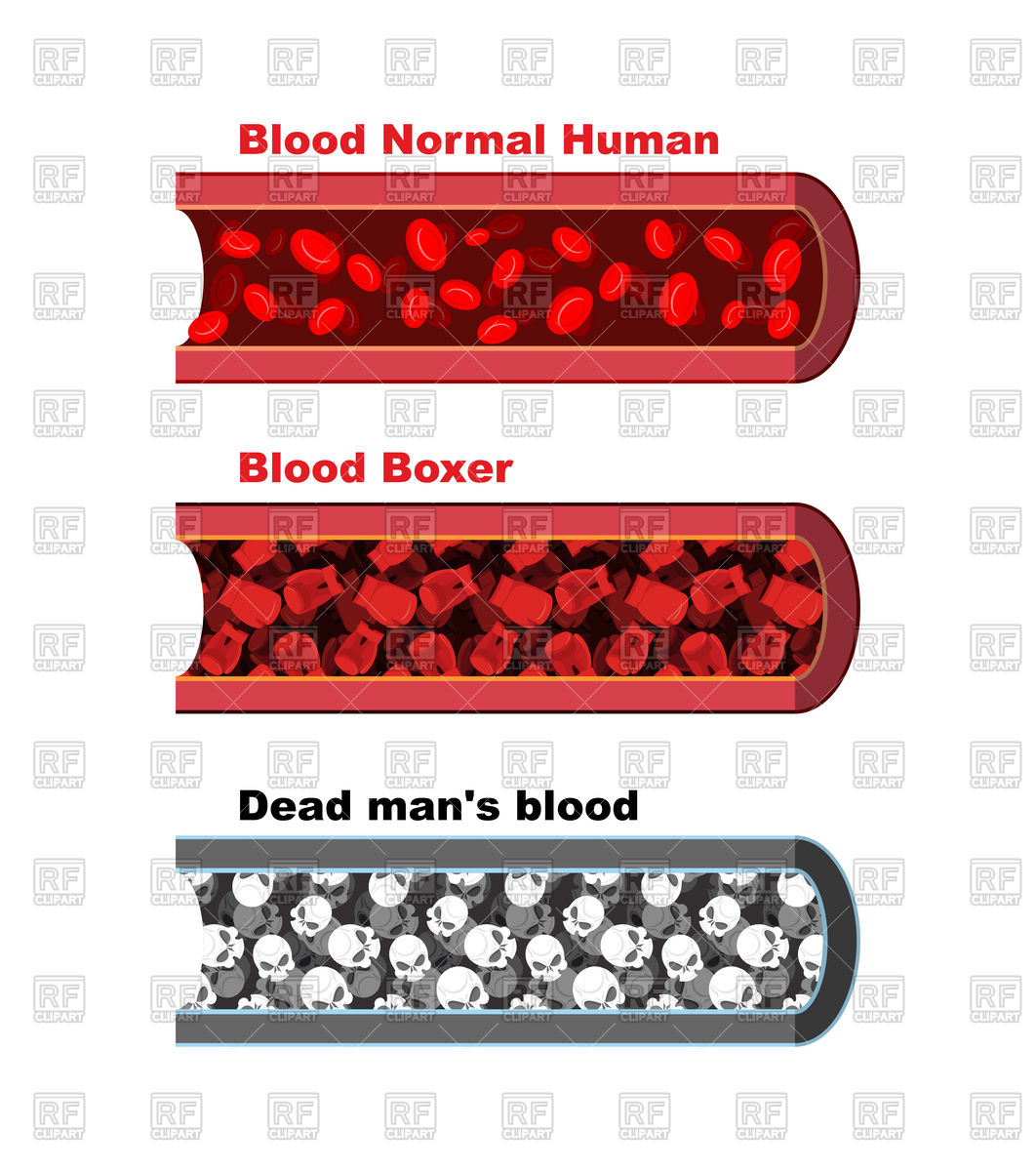1062x1200 Blood Vessel Of Healthy Person With Normal Leukocytes, Bloody