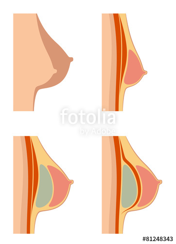 362x500 Breast Implants Stock Image And Royalty Free Vector