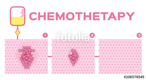 Stage Of Chemotherapy Cure Cancer Cell Vector Stock Image 500x274 Stage Of Chemotherapy Cure Cancer Cell Vector Stock Image
