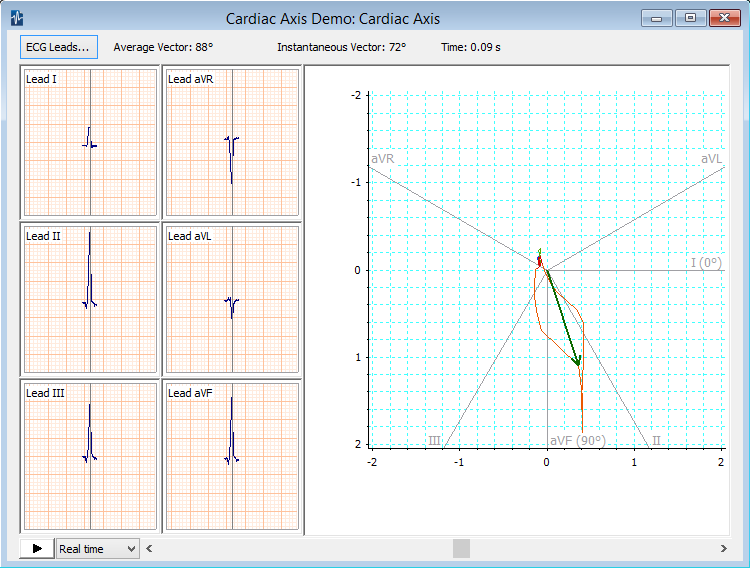 Ecg Cardiac Axis Deviation Heart Axis Deviation Calculator Adi 750x568 Ecg Cardiac Axis Deviation Heart Axis Deviation Calculator Adi