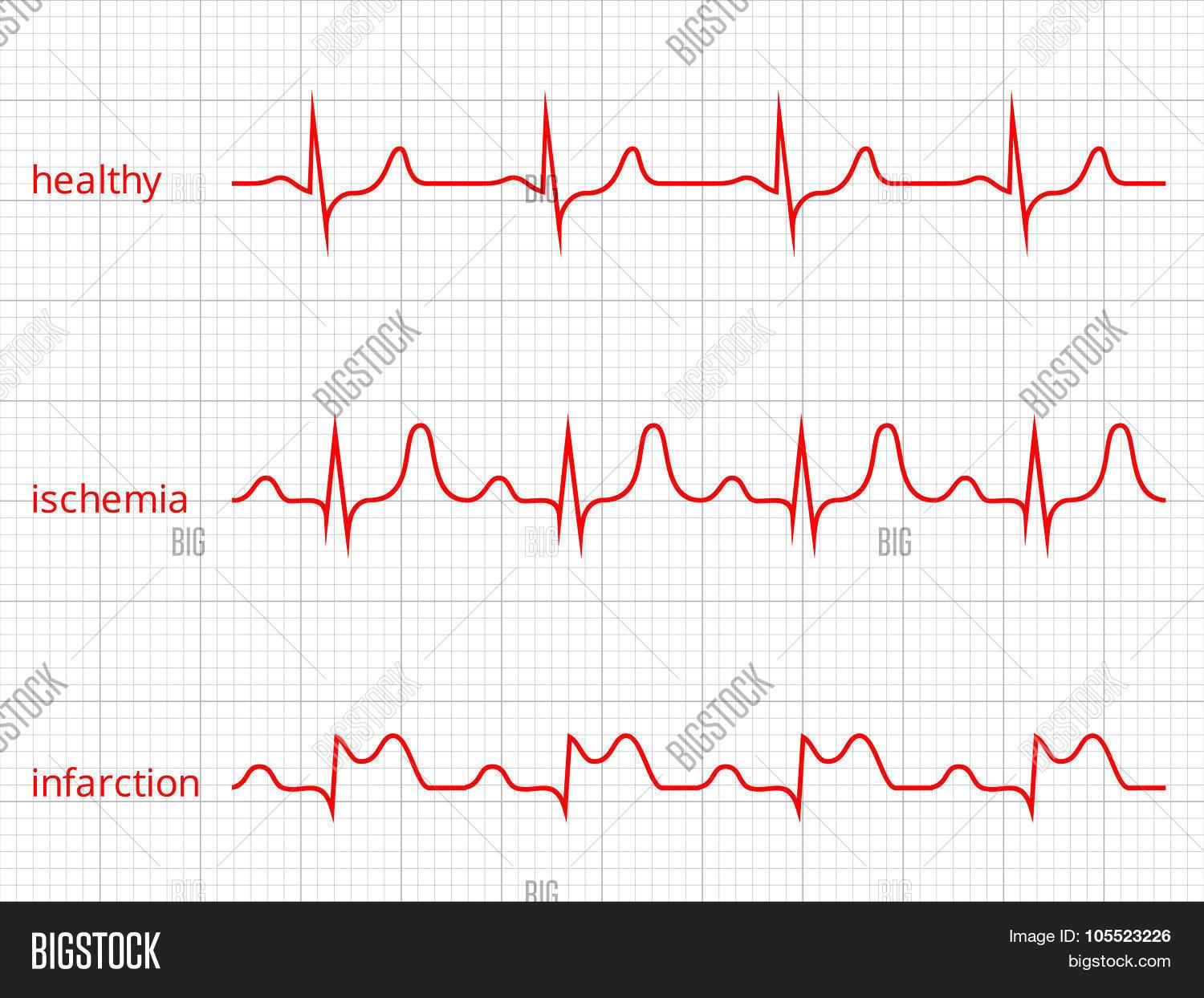 1500x1244 Coronary Heart Cardiogram Vector Charts Set Wholesome Coronary