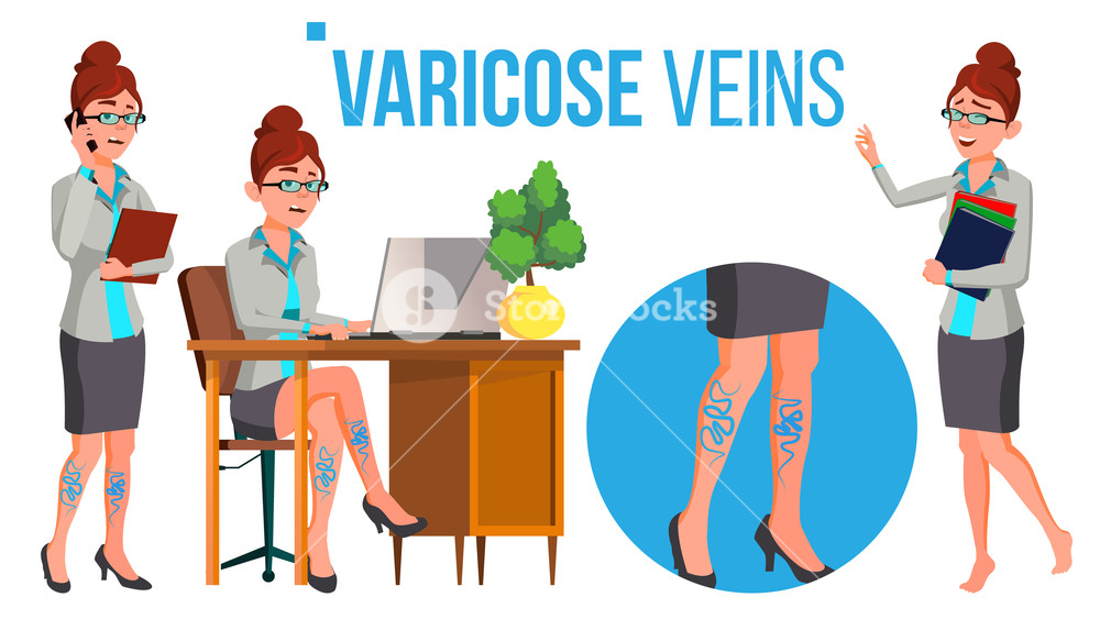 1000x563 Female Legs In High Heel Shoes With Varicose Veins Vector