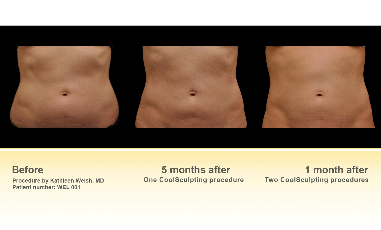1320x795 Winter Slimming With Coolsculpting