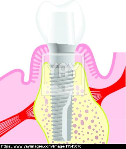 432x512 Dental Implant Vector