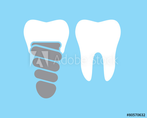 500x402 Dental Implant Vector Icon