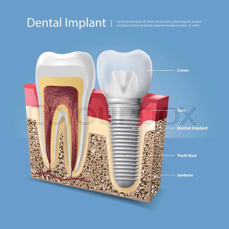 800x800 Human Teeth And Dental Implant Vector Stock Vector Colourbox