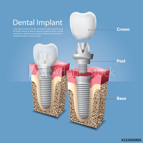 500x500 Human Teeth And Dental Implant Vector Illustration
