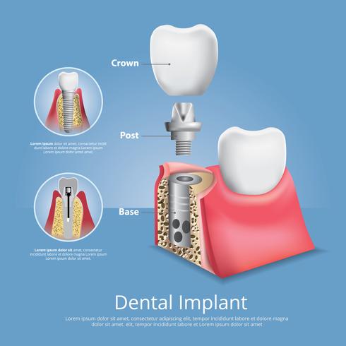 490x490 Human Teeth And Dental Implant Vector Illustration