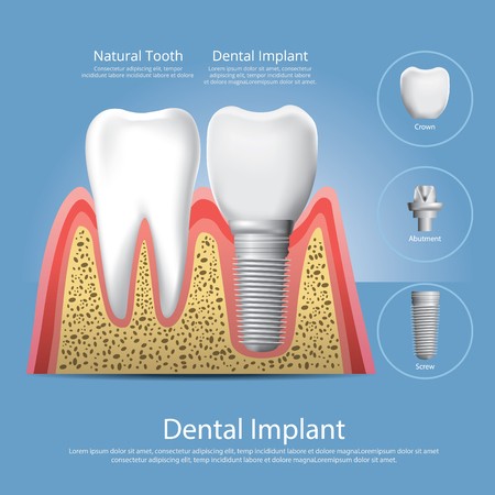 450x450 Human Teeth And Dental Implant Vector Illustration Royalty Free