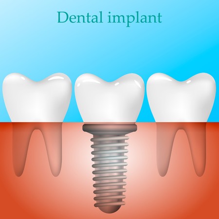 450x450 Human Teeth And Dental Implant Vector Illustration