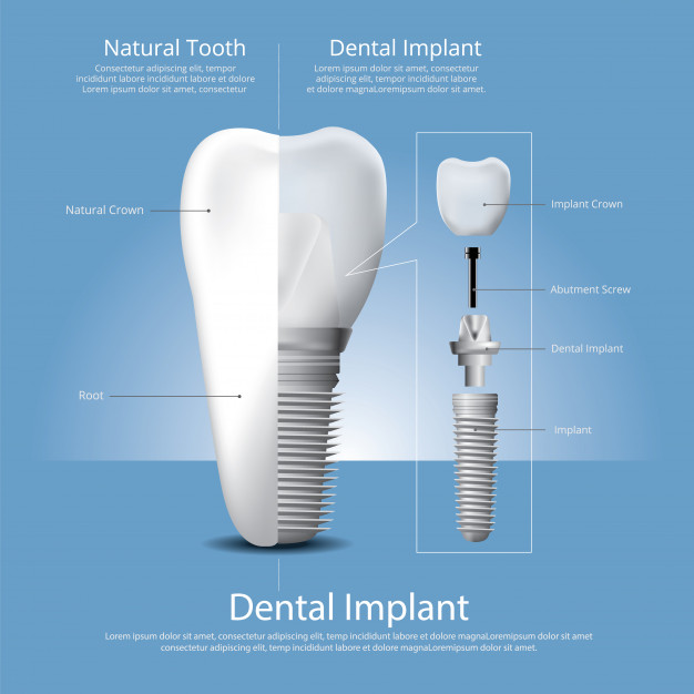 Dental Implant Vector At Vectorified.com | Collection Of Dental Implant ...