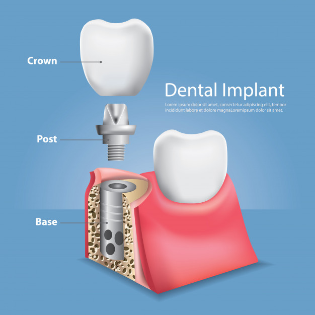 626x626 Human Teeth And Dental Implant Vector Illustration Vector