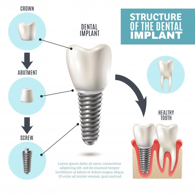 626x626 Implant Vectors, Photos And Free Download