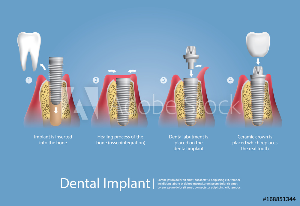 1000x688 Photo Art Print Human Teeth And Dental Implant Vector