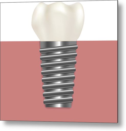 493x515 Realistic Human Dental Implant Vector Metal Print