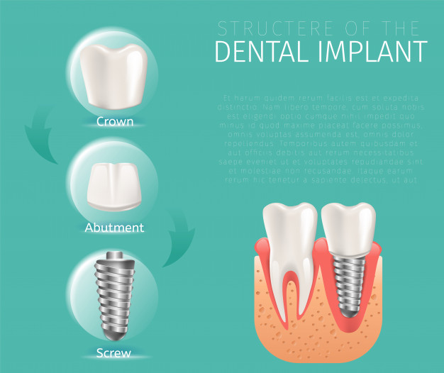 626x526 Realistic Image Structure Of The Dental Implant Vector Premium