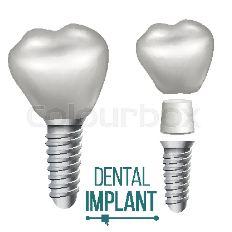 800x800 Dental Implant Vector Medical Poster, Stock Vector Colourbox
