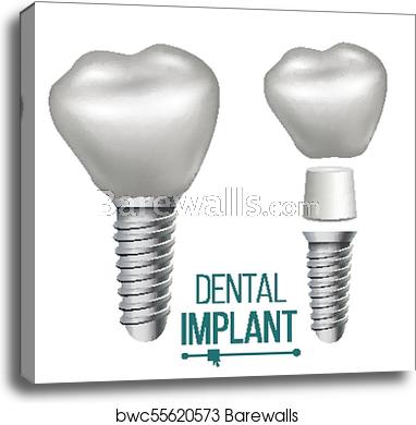 382x390 Dental Implant Vector Medical Poster, Banner Design Element