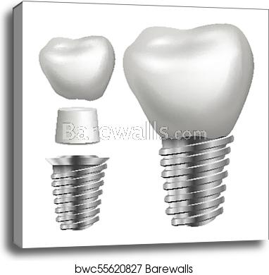 382x390 Dental Implant Vector Side View Graphic Design Element Tooth