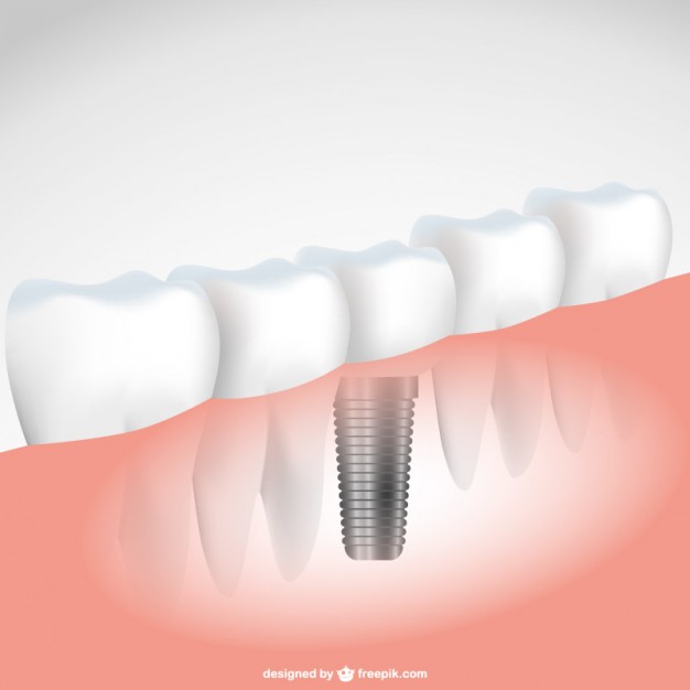 626x626 Dental Implant Vector Free Download
