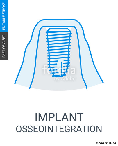 406x500 Dental Implant Vector Icon Stock Image And Royalty Free Vector