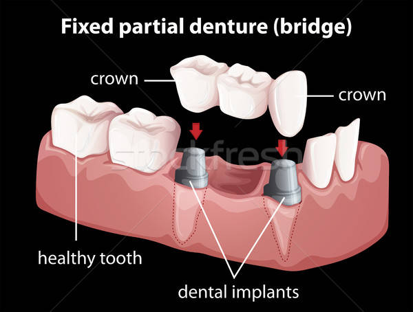 600x454 A Fixed Partial Denture Vector Illustration Daniel Cole