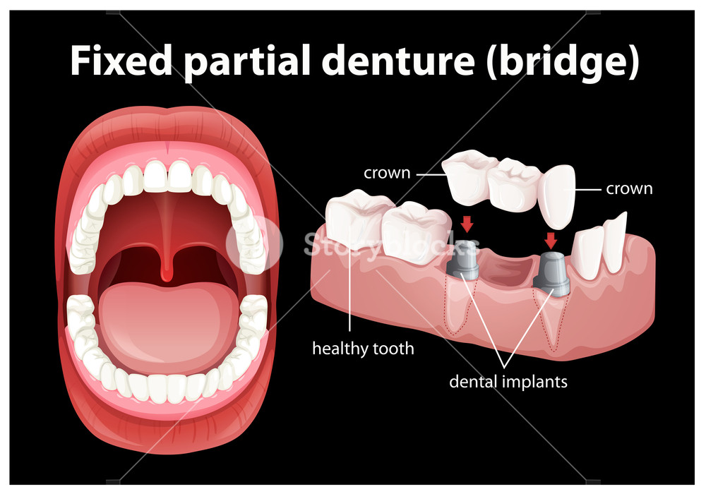 1000x700 Medical Vector Of Fixed Partial Denture Royalty Free Stock Image