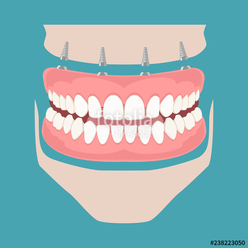 500x500 Removable Denture On Implants Removable Denture Of The Upper