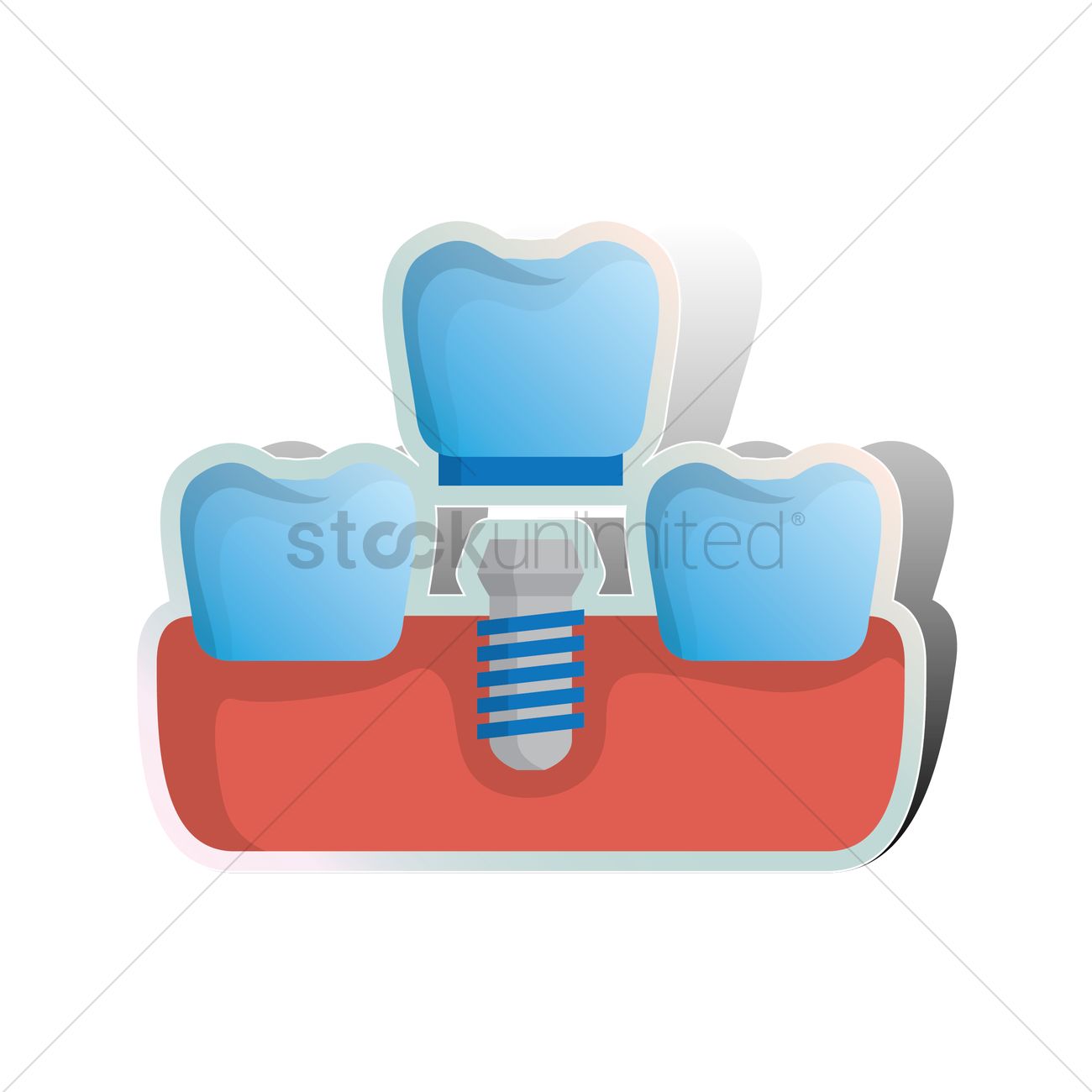 1300x1300 Replacing Missing Tooth With Screw On False Denture Vector Image
