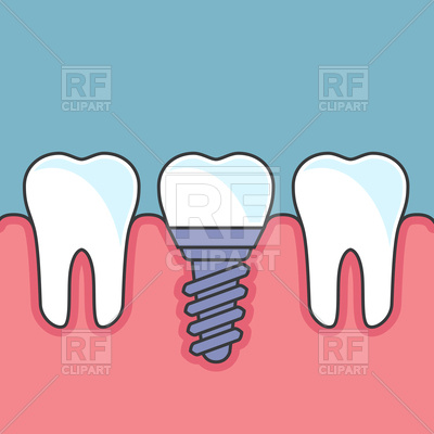 400x400 Row Of Teeth With Dental Implant Vector Image Of Healthcare