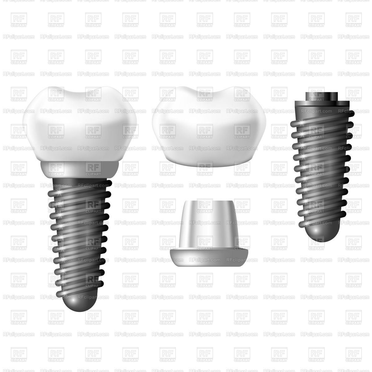 1200x1200 Component Parts Of Dental Implant