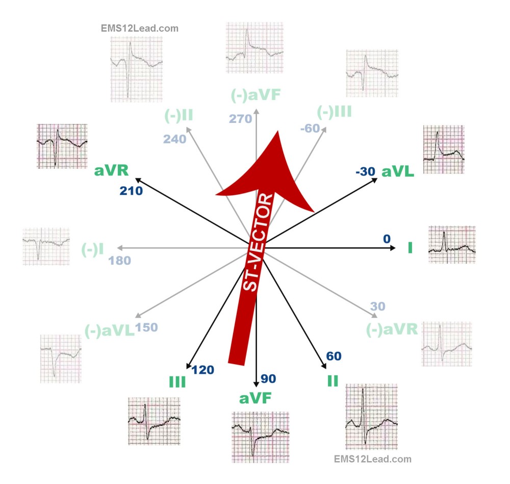 The Degree Heart Part Ii Ems Lead 1000x949 The Degree Heart Part Ii Ems Lead