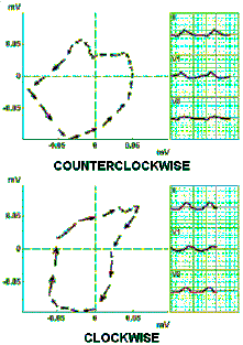 Vector Loops And Ecgs Of A Counterclockwise And B Clockwise 221x313 Vector Loops And Ecgs Of A Counterclockwise And B Clockwise