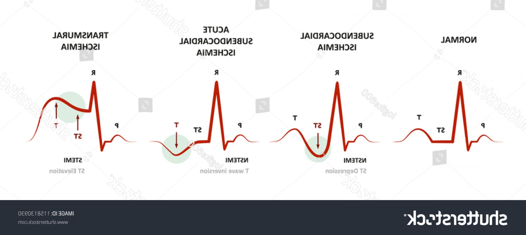 Septal Ekg Vector Catchsplace 1800x807 Septal Ekg Vector Catchsplace