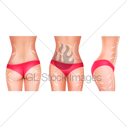 Lines, Showing Surgery On Female Body Vector Gl Stock Images 500x500 Lines, Showing Surgery On Female Body Vector Gl Stock Images