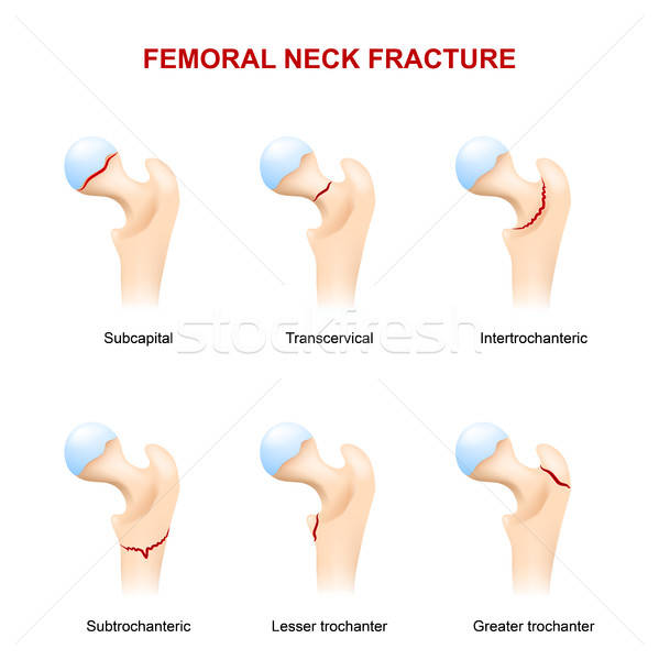 599x600 Fracture Neck Of Femur Vector Illustration Tetiana Zhabska