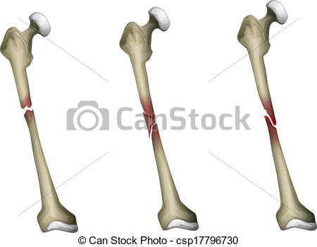 450x350 Three Types Of Bone Fracture In The Femur Vectors