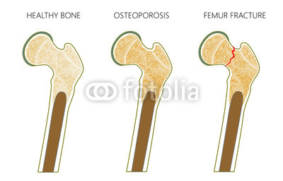 400x256 Vector Illustration Of A Healthy Human Thigh Bone, Osteoporosis