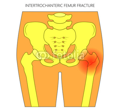 400x368 Vector Illustration Of Healthy Human Hip And Intertrochanteric