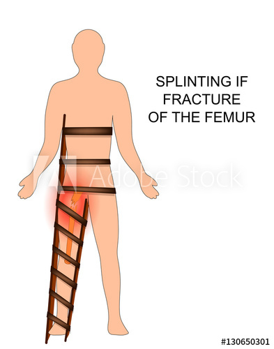 393x500 Fracture And Splinting Of The Femur