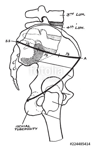 316x500 Displacement Of The Femur, Vintage Illustration Stock Image