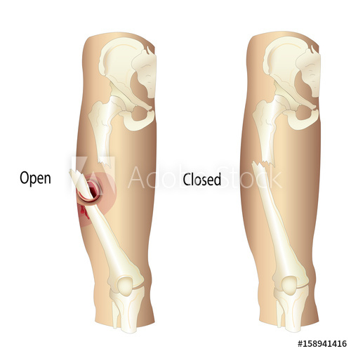500x500 Femur Fractures, Open And Femur Fractures, Closed Vector