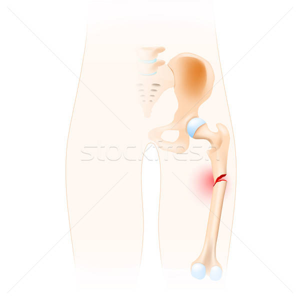 600x600 Femur Stock Photos, Stock Images And Vectors Stockfresh
