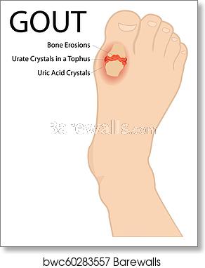 292x382 Gout Arthritis Human Foot Vector Medical Illustration, Art Print