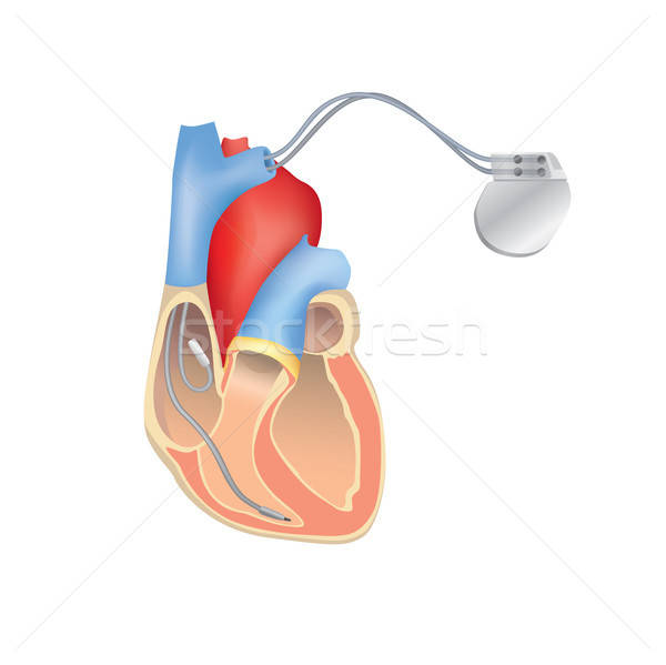 600x599 Heart Pacemaker In Work Human Heart Anatomy With Icd Vector