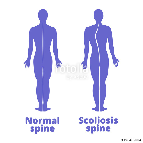 Disease Of A Spine Scoliosis Body Posture Defect Blue Human 500x500 Disease Of A Spine Scoliosis Body Posture Defect Blue Human