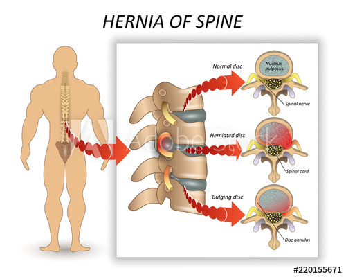 500x400 Anatomy Medical Diagram Of A Human Spine With The Hernia