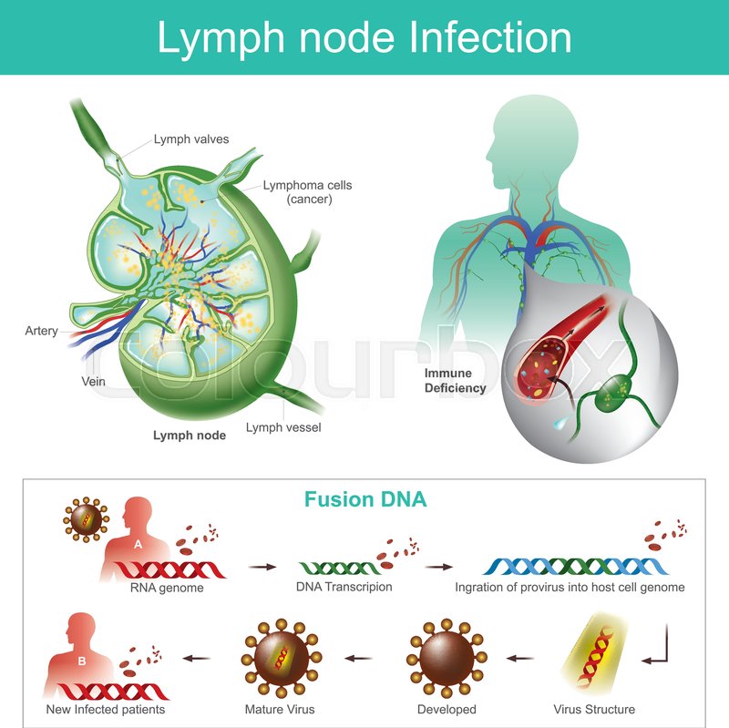 800x799 The Lymph Nodes Are Infected Failure Stock Vector Colourbox